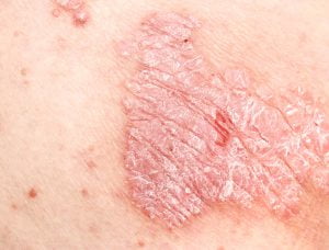 Foto della psoriasi