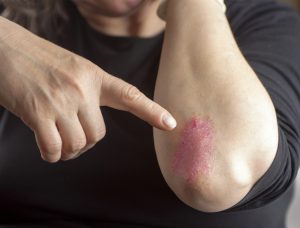 Foto della psoriasi da stress