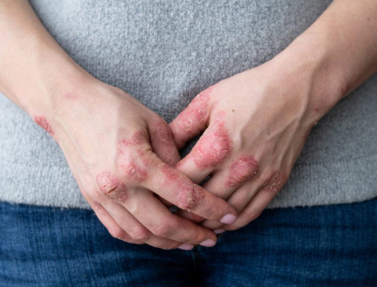 Foto soffro di psoriasi