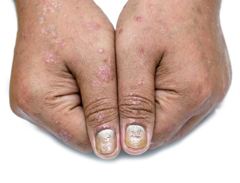 psoriasi alle unghie