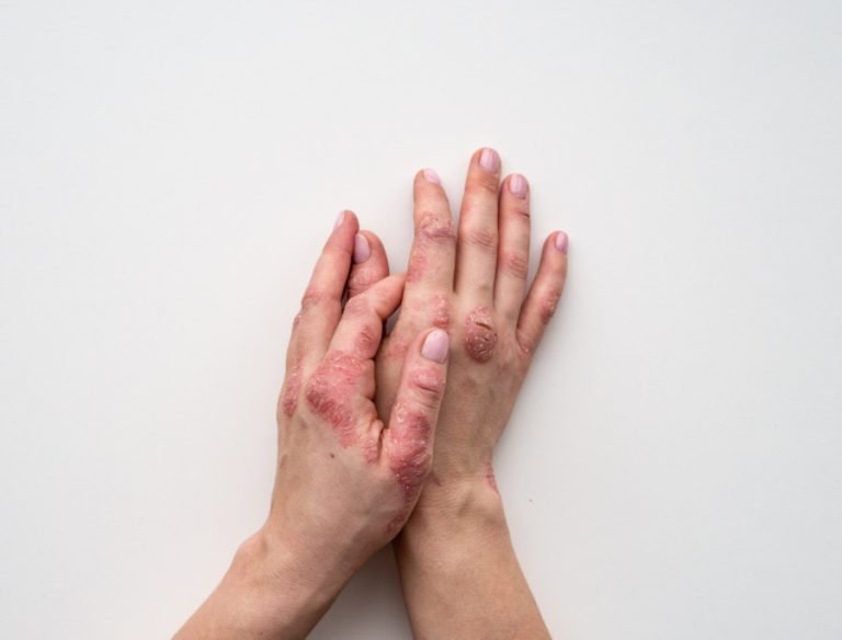 Psoriasi alle mani