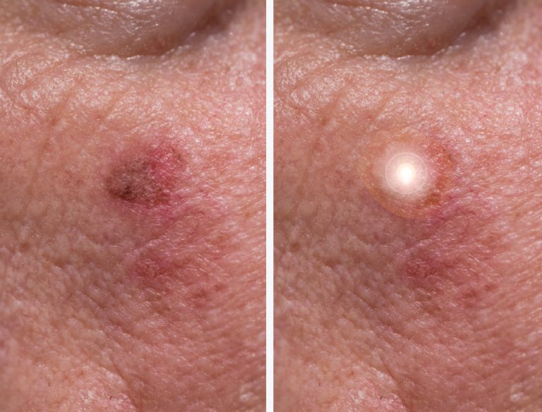 Cheratosi attinica e terapia fotodinamica
