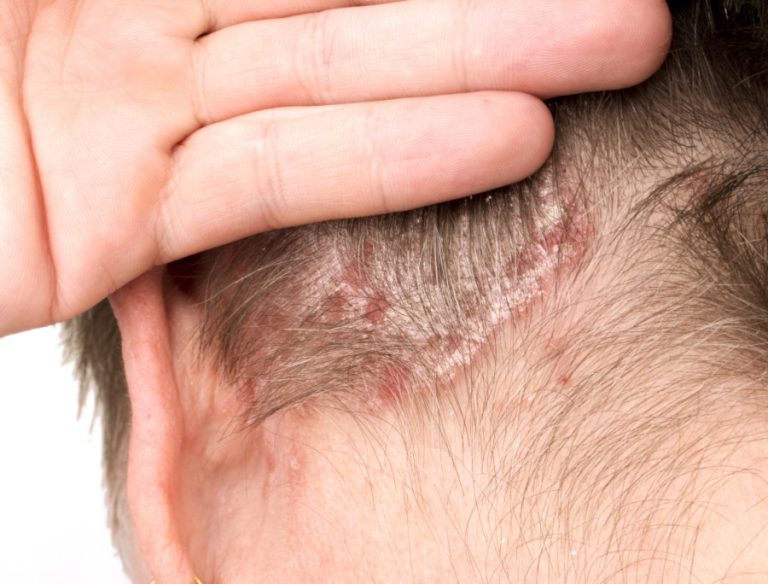Psoriasi cuoio capelluto