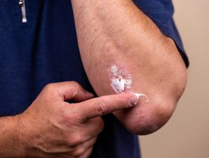 Nuove terapie psoriasi