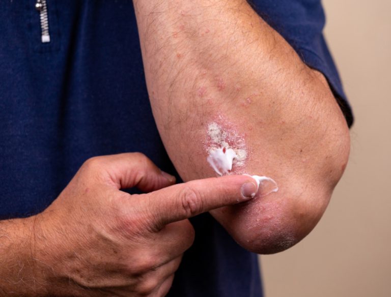 Nuove terapie psoriasi