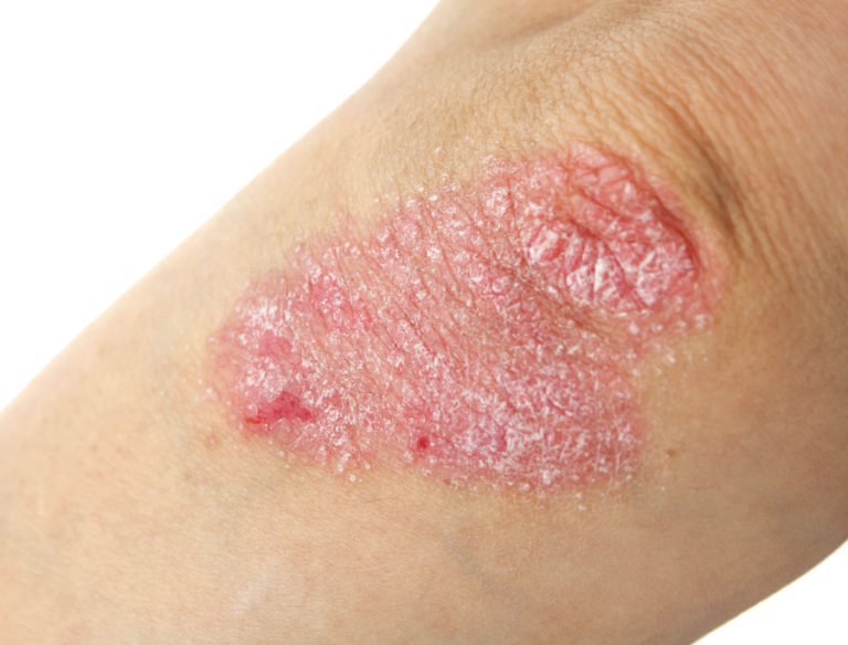 Psoriasi più comune