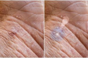 Cheratosi attinica e terapia laser