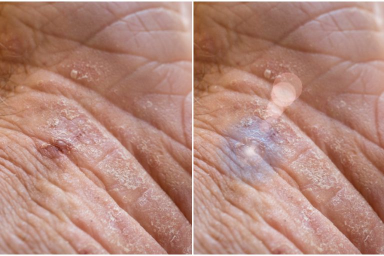 Cheratosi attinica e terapia laser