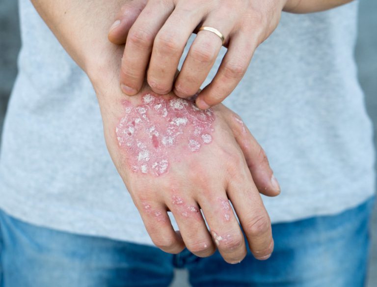 Psoriasi come lavarsi