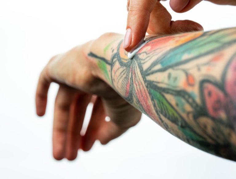 Psoriasi e tatuaggi