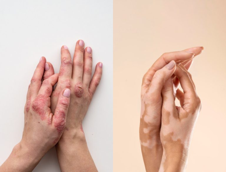 Psoriasi e vitiligine