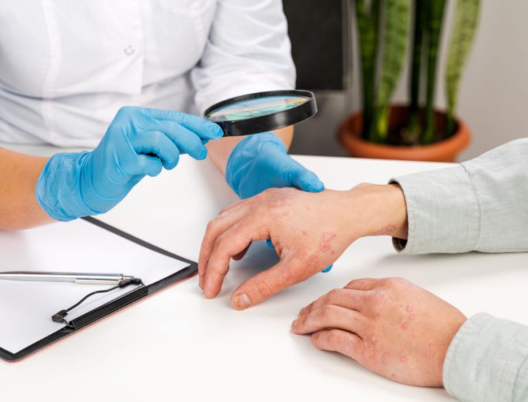 Medici che curano la psoriasi