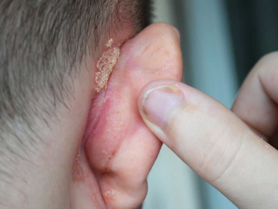Psoriasi inversa orecchio