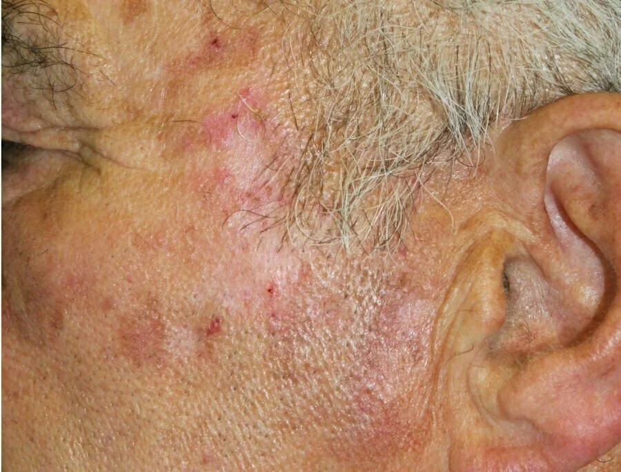 Come Acquistare Il Imiquimod