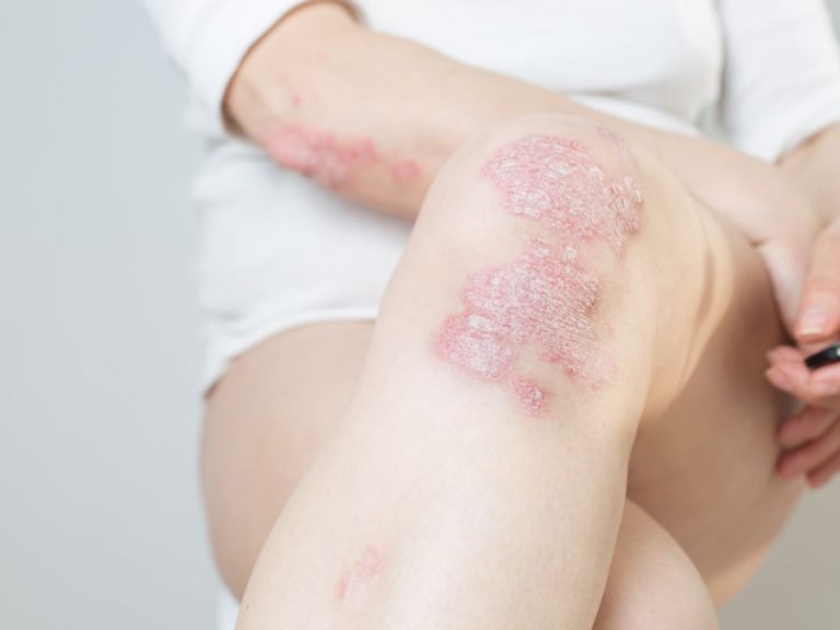 Farmaci da evitare con psoriasi