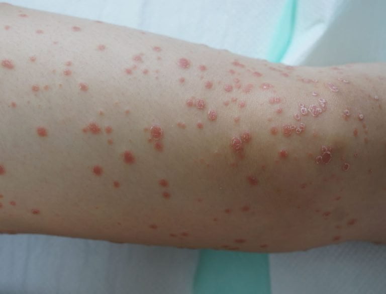 Psoriasi guttata