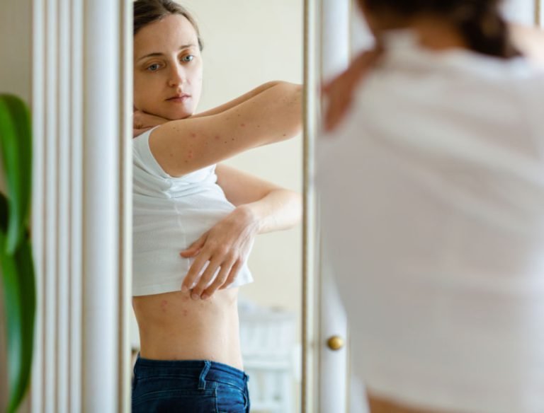 Psoriasi e lampade abbronzanti