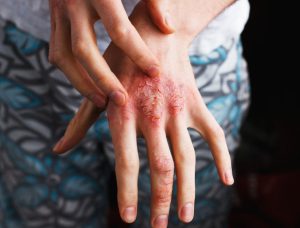 Psoriasi prevenire le infezioni sulla pelle