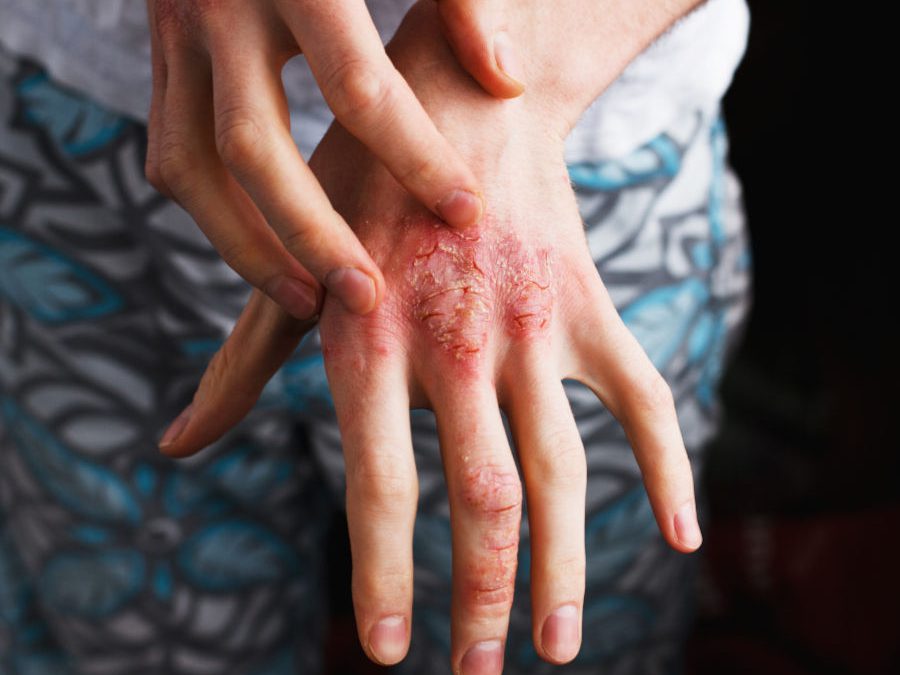 Psoriasi prevenire le infezioni sulla pelle