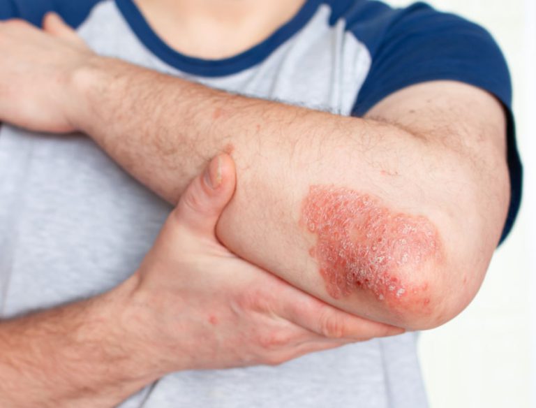 Psoriasi volgare