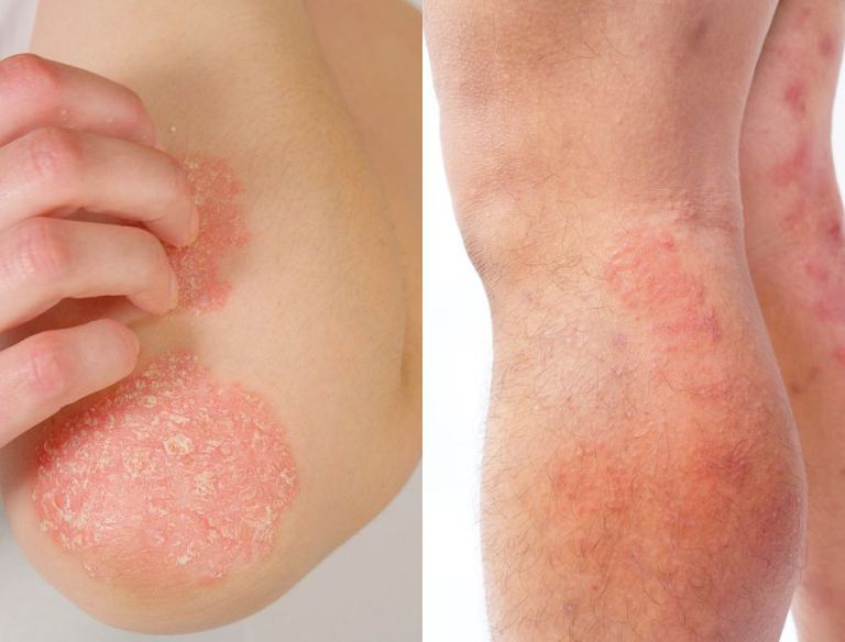 Differenza tra dermatite atopica e psoriasi