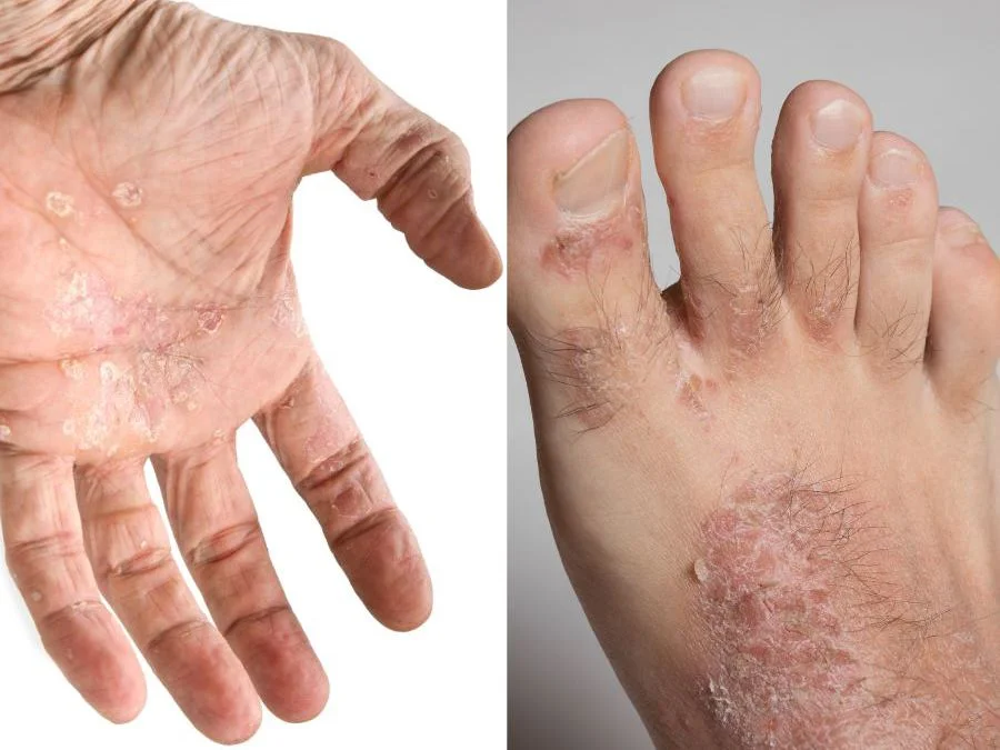 Sintomi della psoriasi delle mani e dei piedi - Derma-Point
