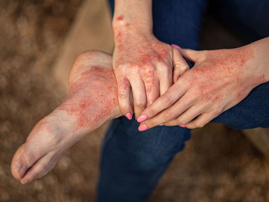 Che cos’è la dermatite atopica