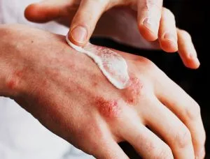 Come curare dermatite atopica in modo naturale