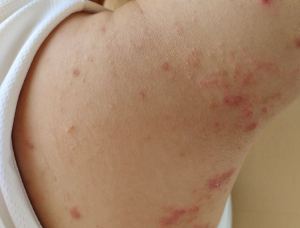 Dermatite atopica come lavarsi