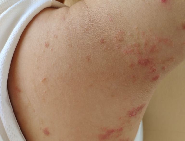 Dermatite atopica come lavarsi