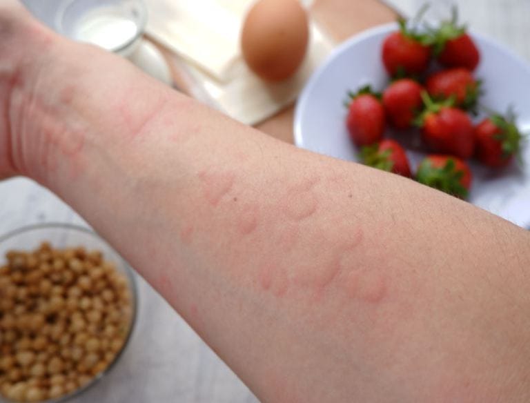 Cosa non mangiare con la dermatite atopica