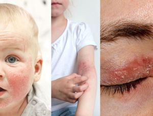 Dermatite atopica sintomi