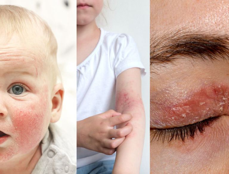 Dermatite atopica sintomi