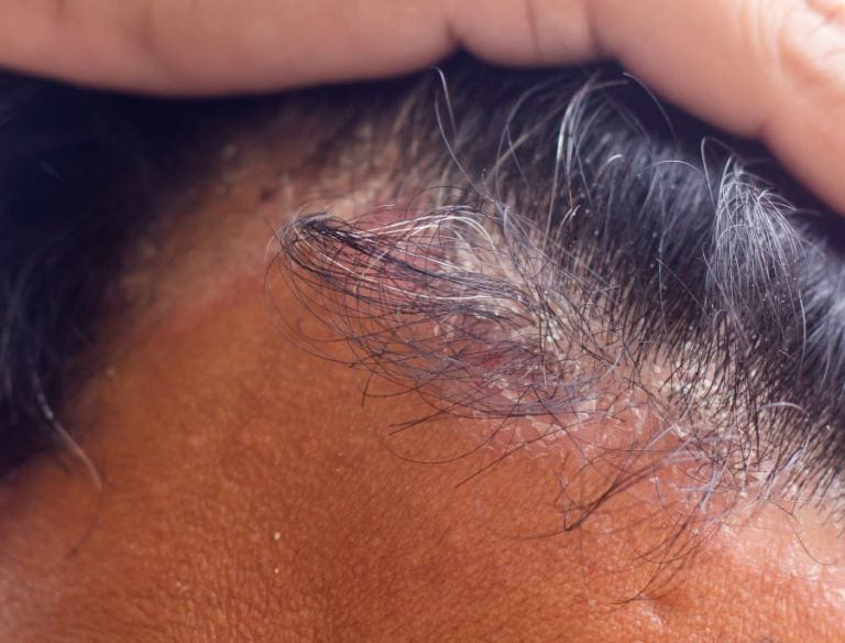 Dermatite atopica cuoio capelluto