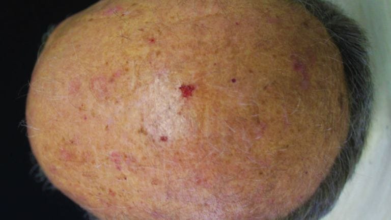 Cheratosi attinica sul cuoio capelluto