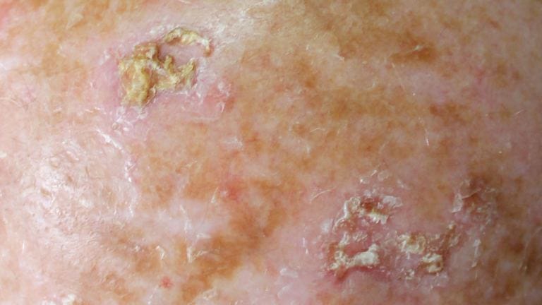 Dettaglio di una lesione da cheratosi attinica