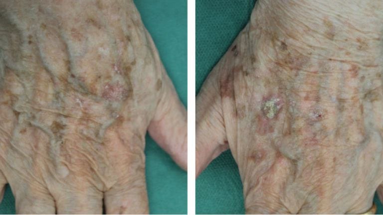 Cheratosi attinica sulle mani