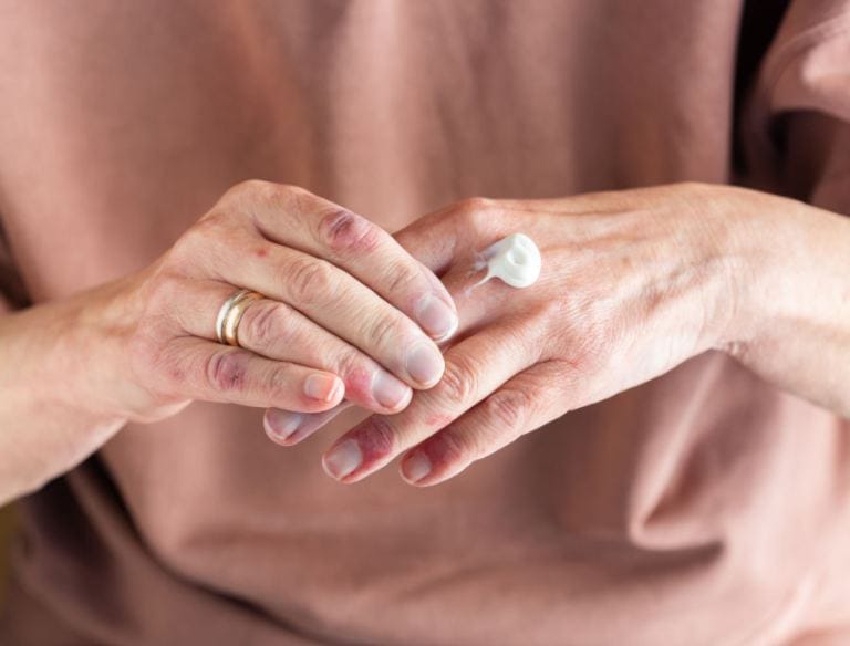 Come curare la dermatite atopica