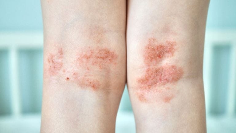 Dermatite atopica sulle ginocchia