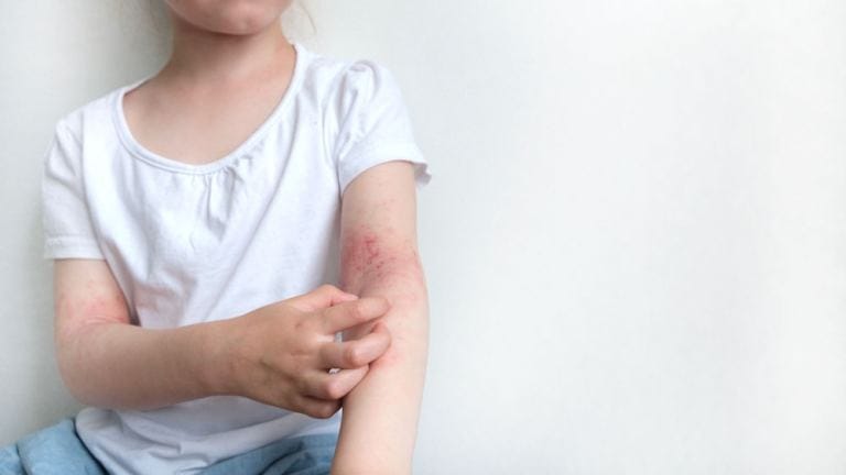 Dermatite atopica sull'interno del gomito