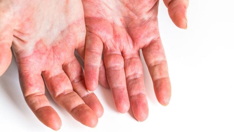 Dermatite atopica sulle mani