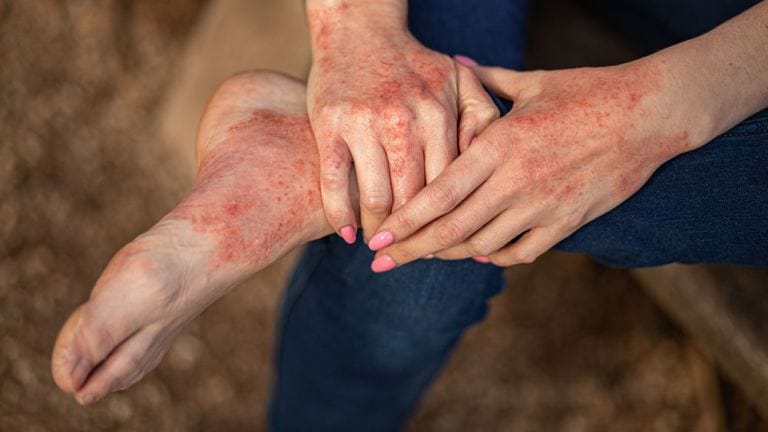 Dermatite atopica su mani e piedi