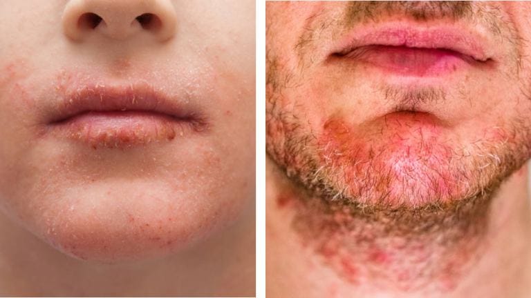 Differenza tra dermatite atopica e seborroica