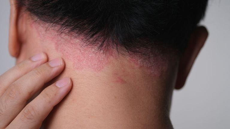 Psoriasi sul cuoio capelluto