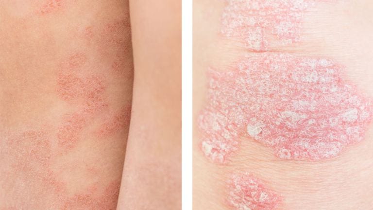 Differenza tra psoriasi e dermatite atopica