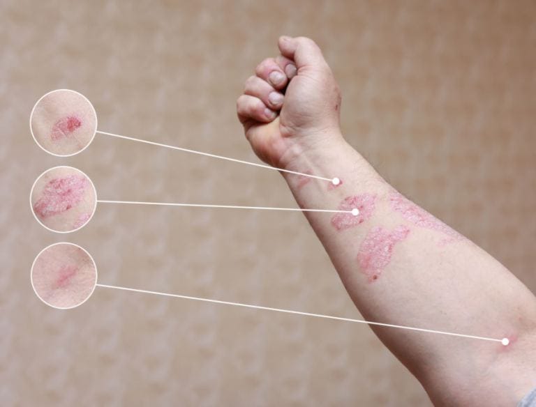 Psoriasi dolore