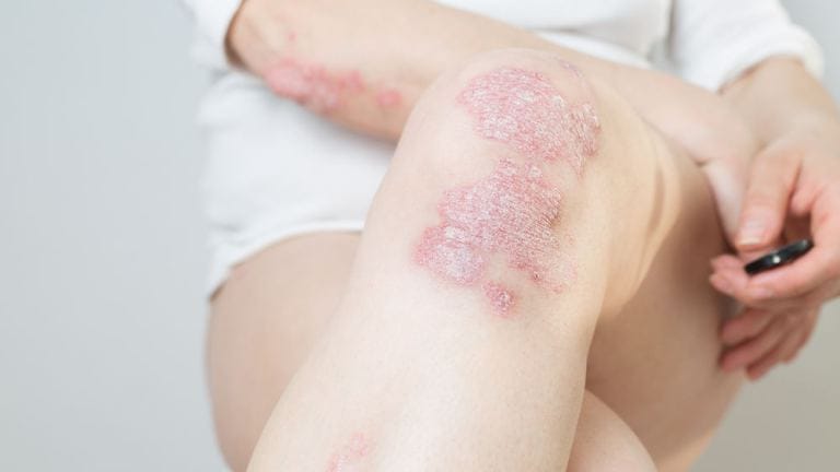 Psoriasi sul ginocchio
