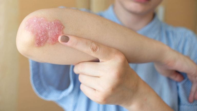 Psoriasi sul gomito