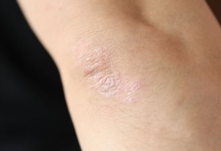Psoriasi lieve guarire