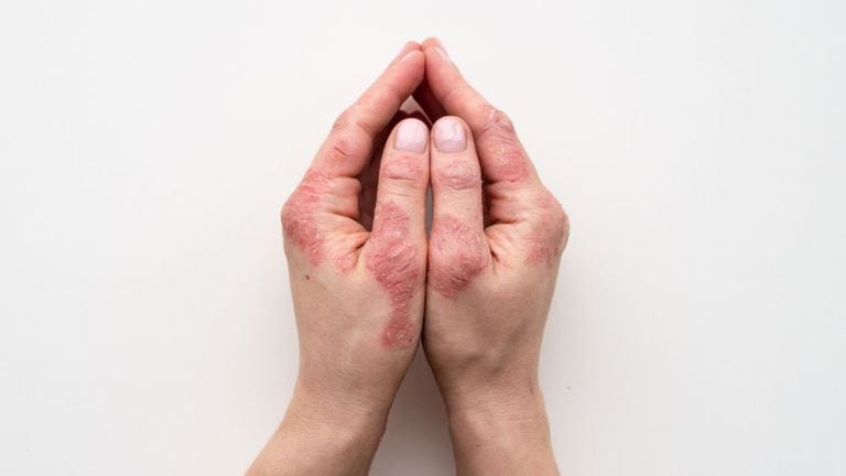 Psoriasi sulle mani